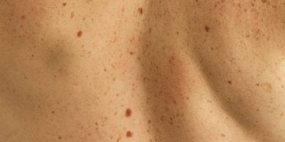 5 maneras de tratar las manchas de la piel con cambios en el estilo de vida