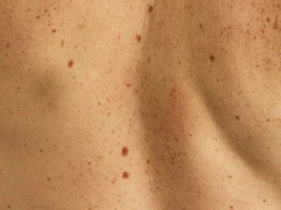 5 maneras de tratar las manchas de la piel con cambios en el estilo de vida