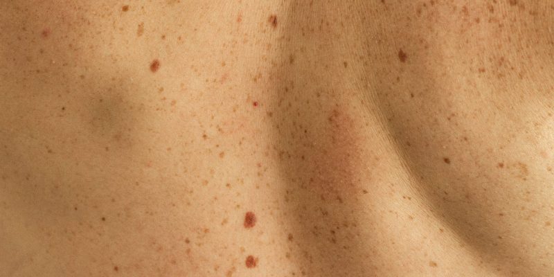 5 maneras de tratar las manchas de la piel con cambios en el estilo de vida